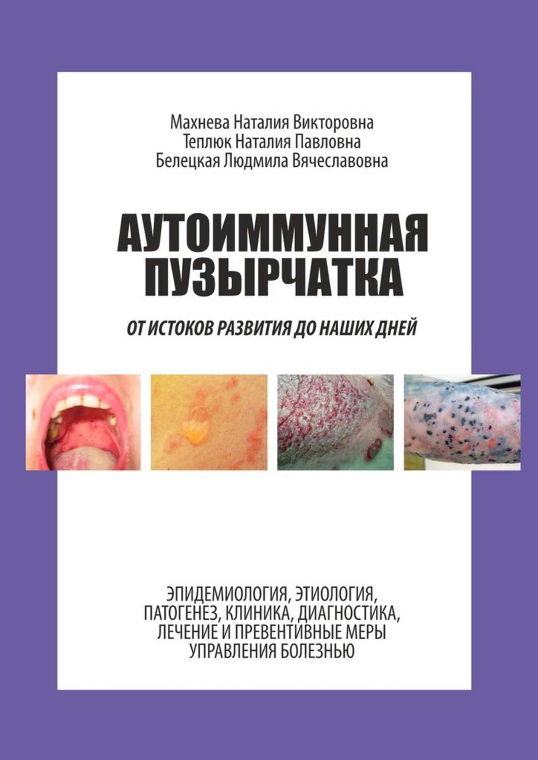 Обложка книги «Аутоиммунная пузырчатка. От истоков развития до наших дней»