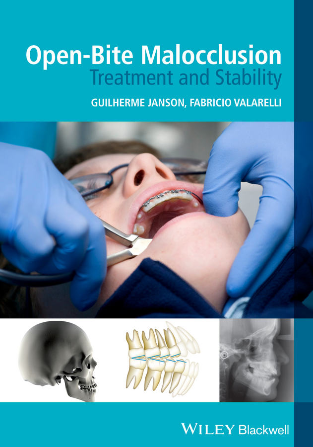 Обложка книги «Open-Bite Malocclusion. Treatment and Stability»
