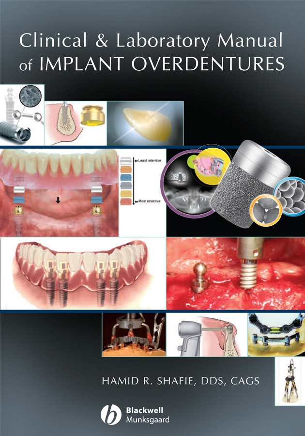 Обложка книги «Clinical and Laboratory Manual of Implant Overdentures»