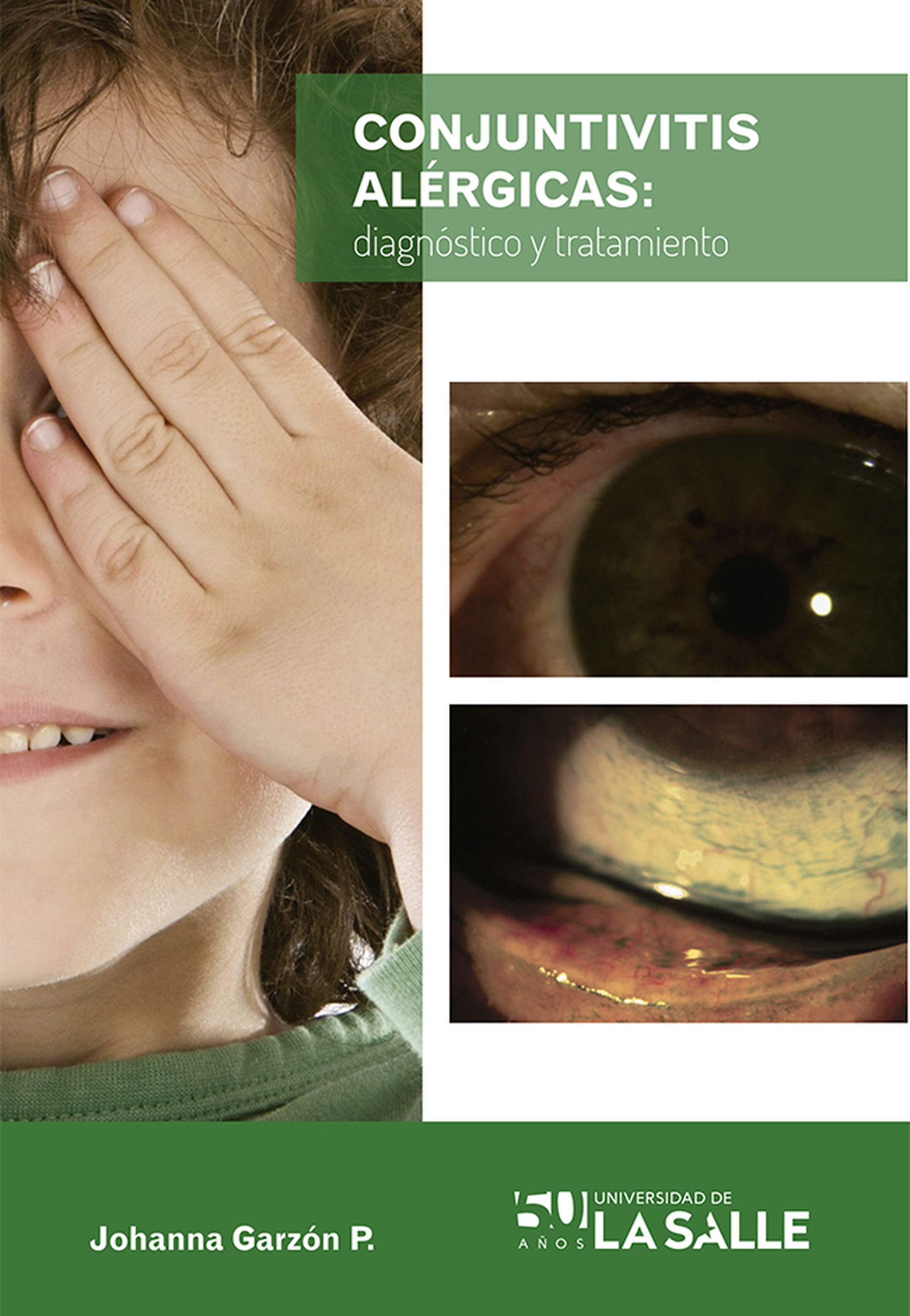 Обложка книги «Conjuntivitis alérgicas»