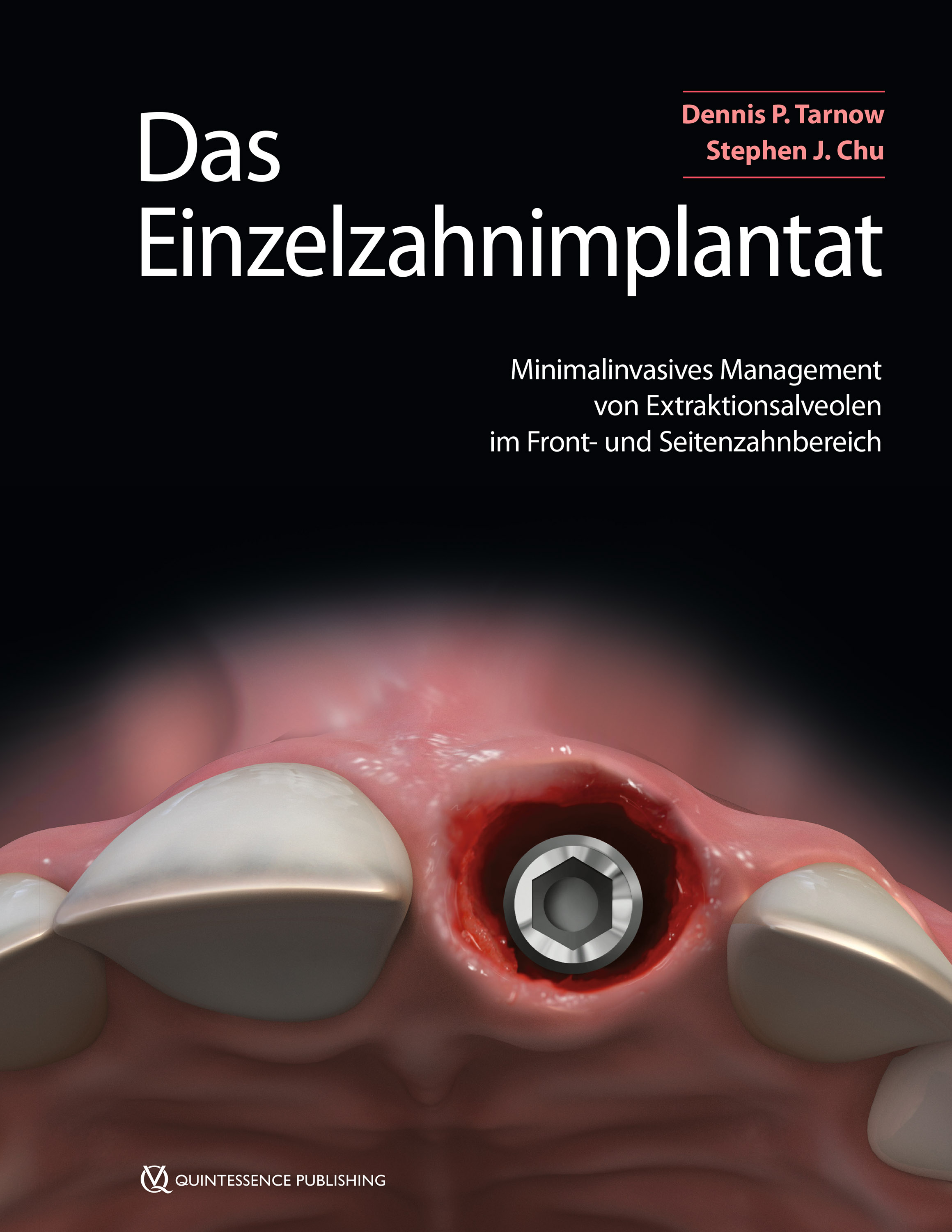 Обложка книги «Das Einzelzahnimplantat»