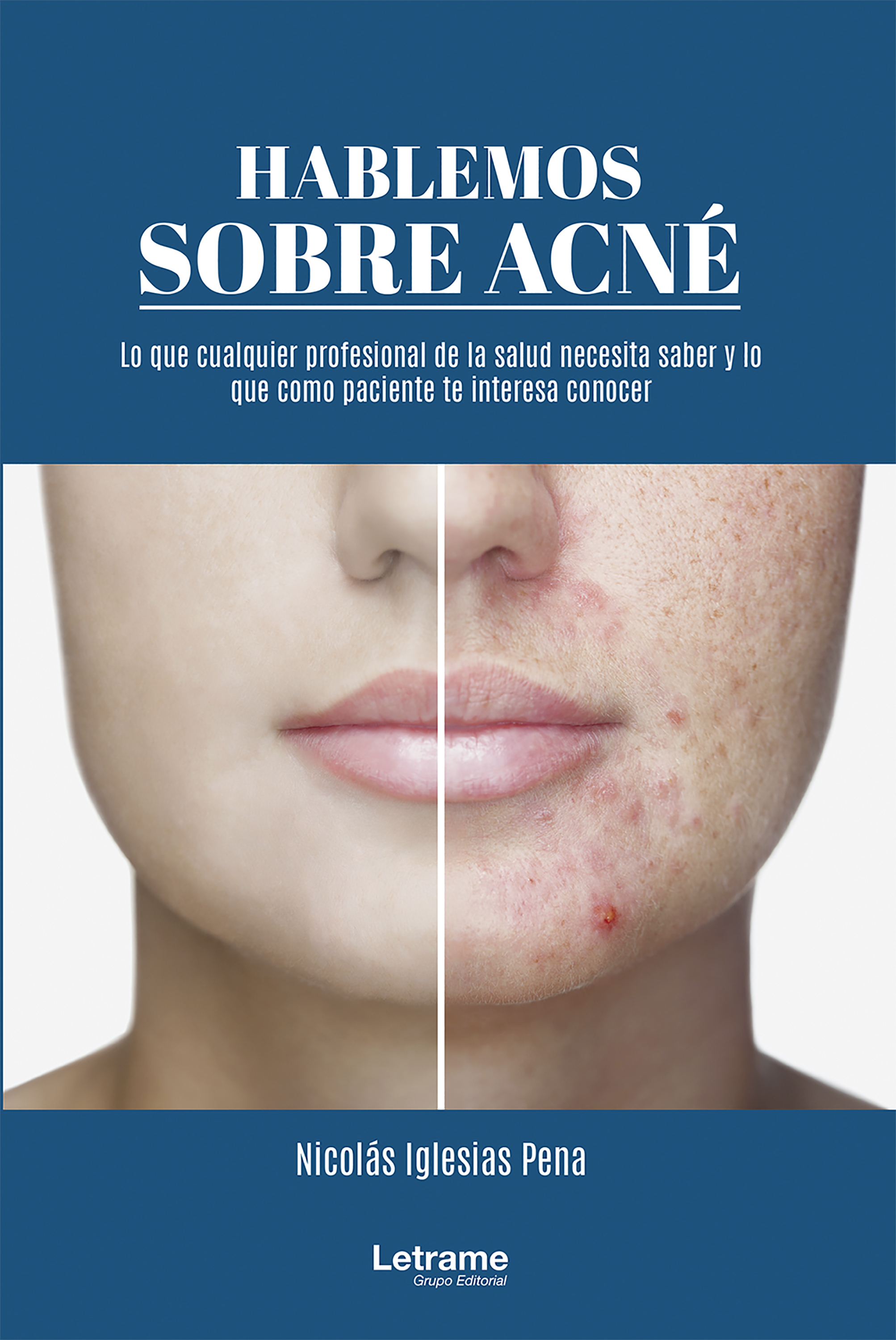 Обложка книги «Hablemos sobre acné»