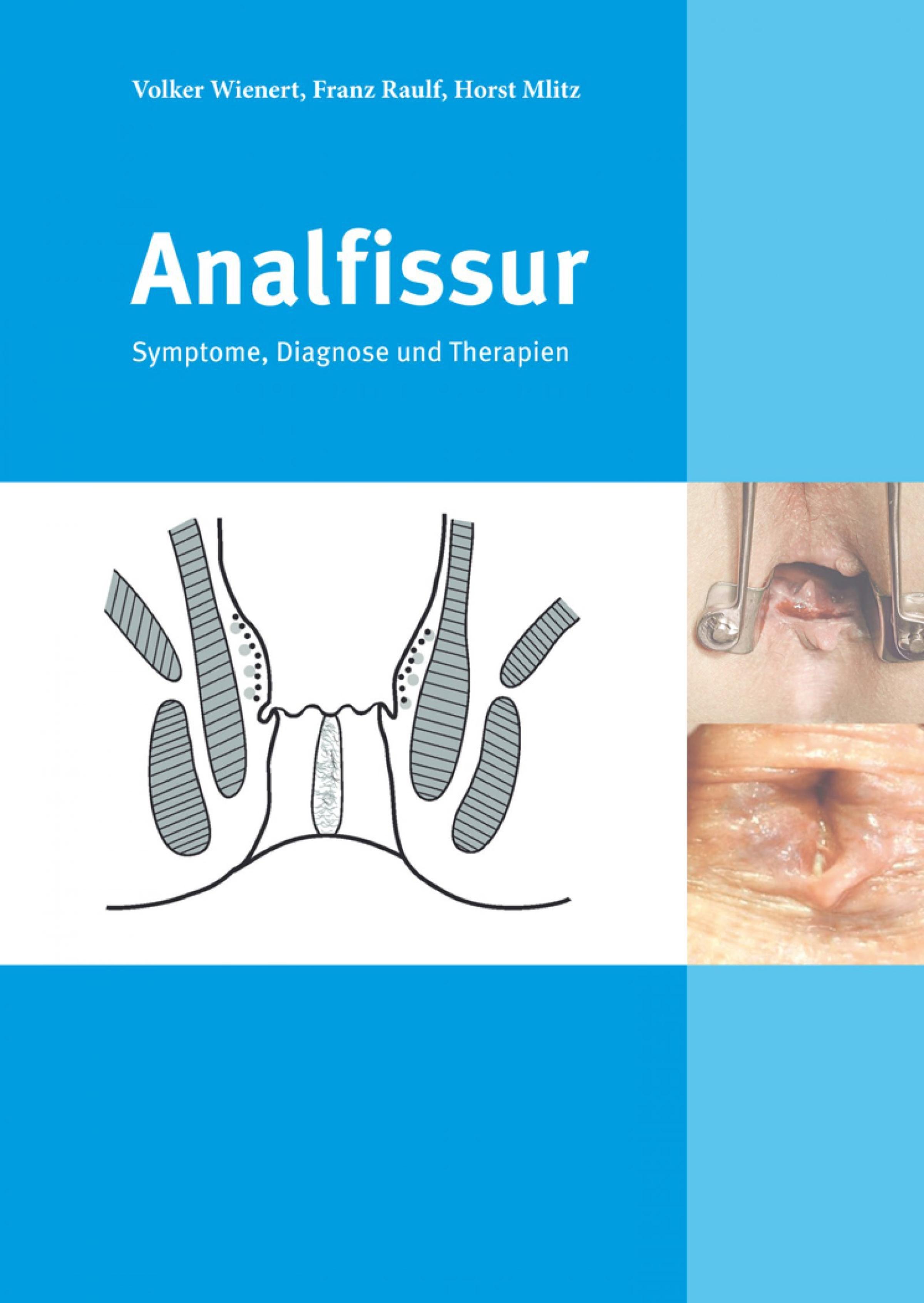 Обложка книги «Analfissur»