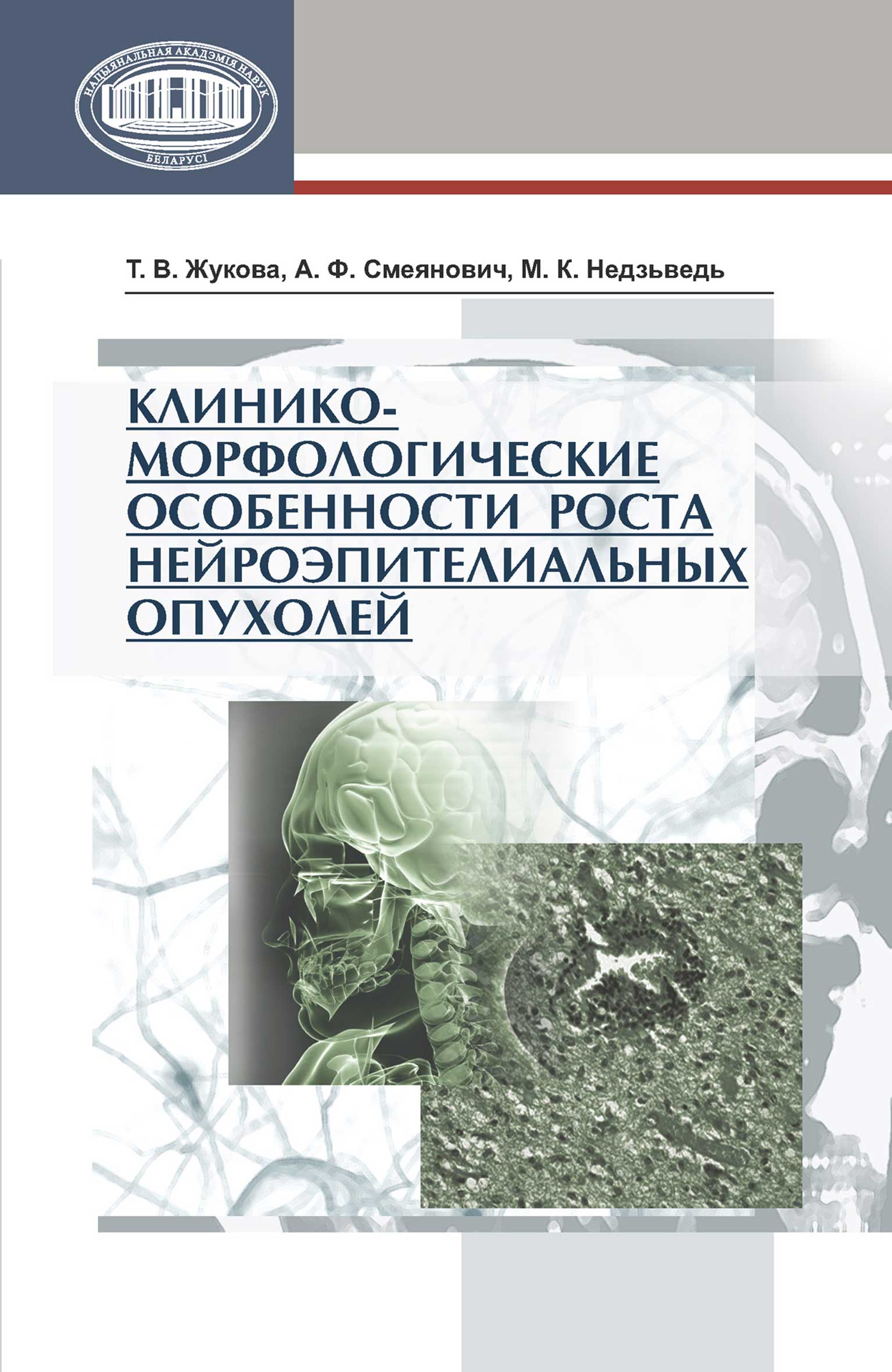 Обложка книги «Клинико-морфологические особенности роста нейроэпителиальных опухолей»